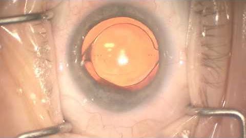 Piggyback IOL for Refractive Surprise (B&L Sofport LI61AO)