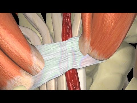 Video: Cómo diagnosticar el síndrome del túnel carpiano: 12 pasos (con imágenes)