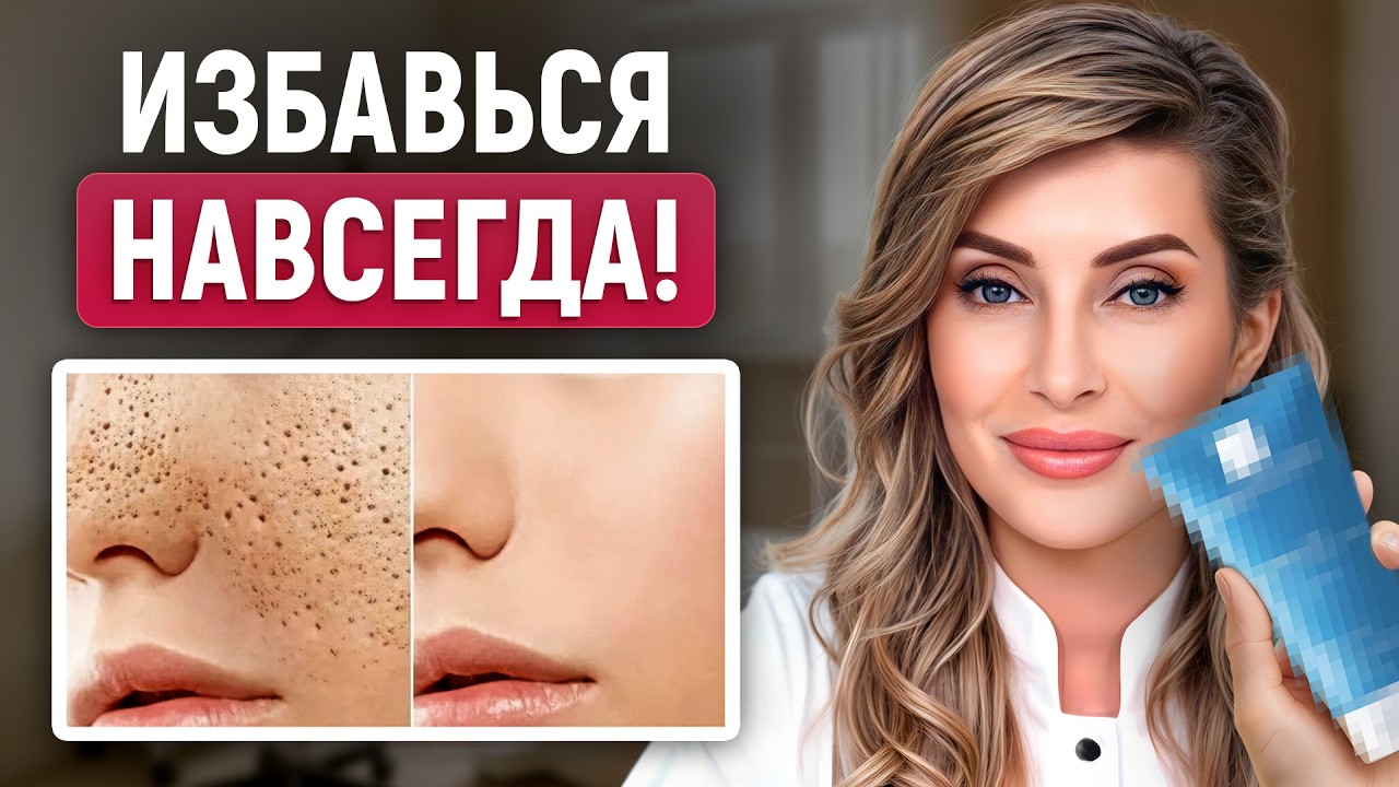 ЭТИ средства работают на 100%! / 6 ЛУЧШИХ способов ЛЕГКО избавиться от черных точек