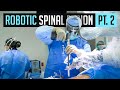 Robotic Spinal Fusion | Part 2