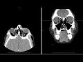 CT (computed tomography) face radiology search pattern