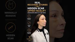 This Isn’t Just a Brow Lift — It’s an Upper Facelift | Real Recovery Story