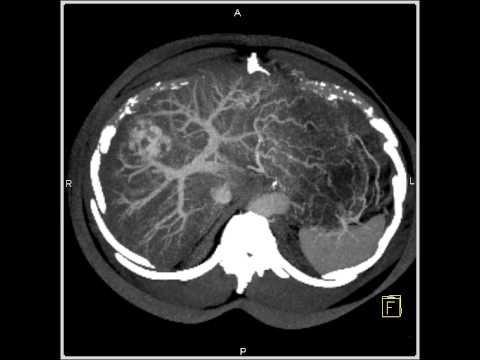 Abdomen: Liver:CT demonstrates a hemangioma of the liver because of the fatty infiltration(10 of 10)