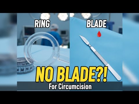Bloodless Circumcision?! The Plastibell Technique Every Parent Should Know