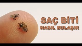 Saç Biti Nasıl Bulaşır?