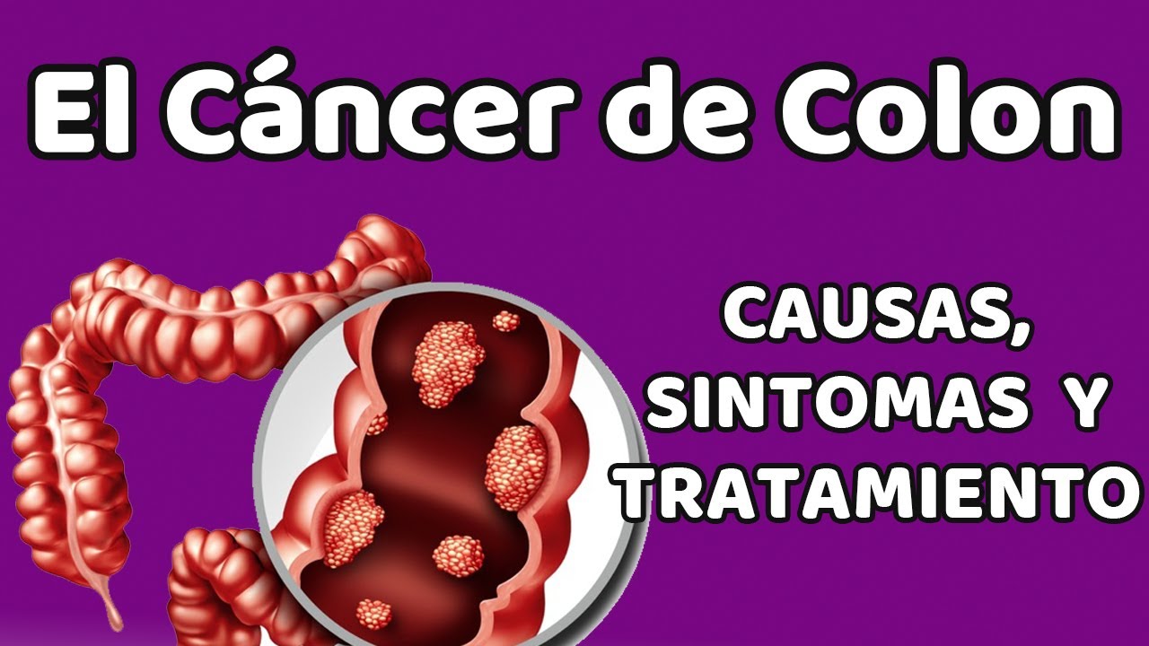 El CÁncer De Colon Causas Signos Y Síntomas Diagnóstico Y Tratamiento Youtube