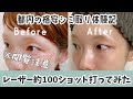 【⚠︎閲覧注意⚠︎】7日間密着!気になってた格安シミ取りレーザー体験記 | クリニック・お値段・ダウンタイム・アフターケアなど全部公開!