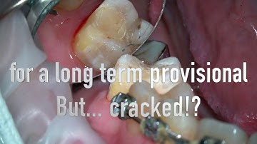 Direct composite overlay Part 1