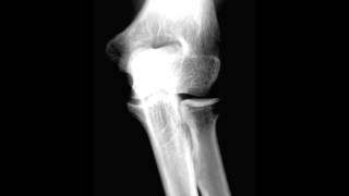 Detailed Normal Elbow on X ray Information