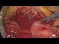 Totally laparoscopic management of inferior mesenteric artery injuries in colorectal surgery