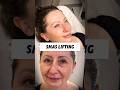 Small-cut lift that tightens naturally with quick healing. #MiniLift #FaceTight