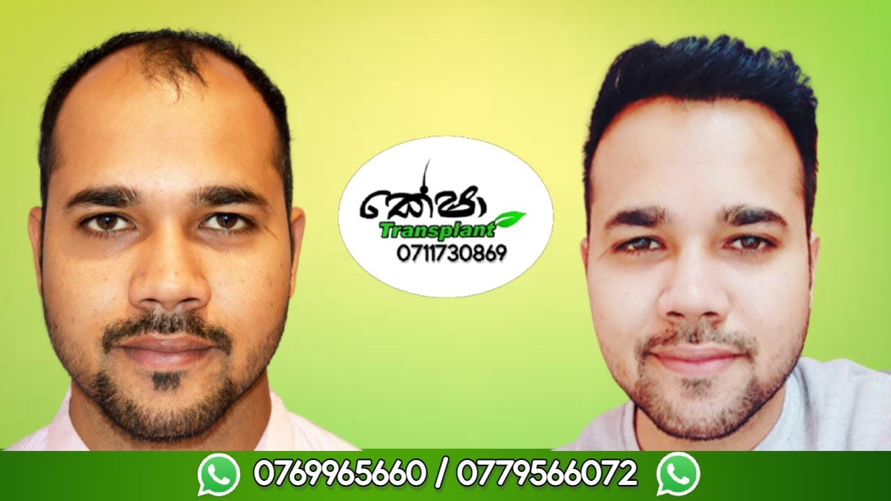 What vitamins to grow hair after a hair transplant? Sapphire Hair