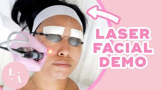 Lasers Did What to Her Face?! | Laser Facial Demo