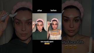 I CAN’T BELIEVE THIS HAPPENED ✨️ #hyperpigmentation #acnetreatment #acnescars #clearskin #darkspots