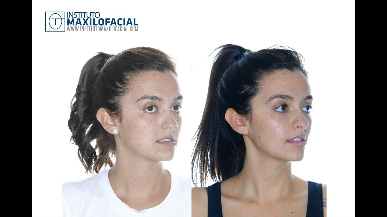 Orthognathic monomaxillary surgery. Case # 61: Maria- Class 3, cross bite