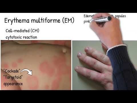 Erythema Multiform - Simply explained,  skin redness and rush. pink-red ring around a pale center