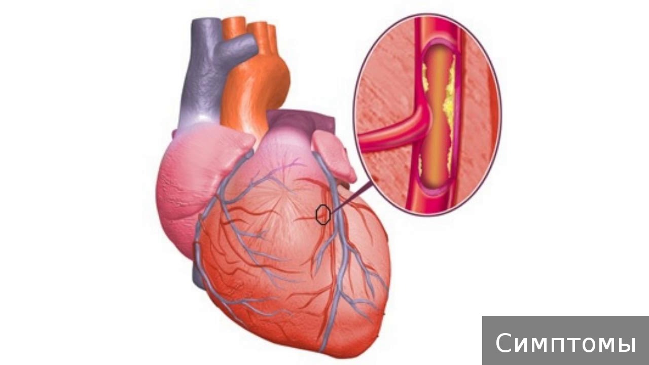 Тромбоз коронарных артерий. 1.1. Ишемическая болезнь сердца. ИБС атеросклеротический кардиосклероз. Атеросклероз ИБС стенокардия. Атеросклероз венечных артерий сердца.