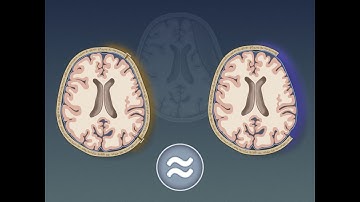 Craniectomie versus craniotomie bij acuut subduraal hematoom | NEJM