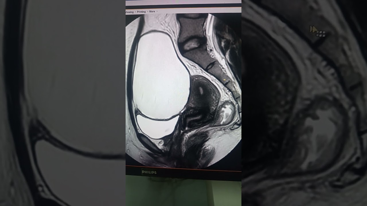 Mri of Pelvis Post contrast T1w fs and T2w THIN cut