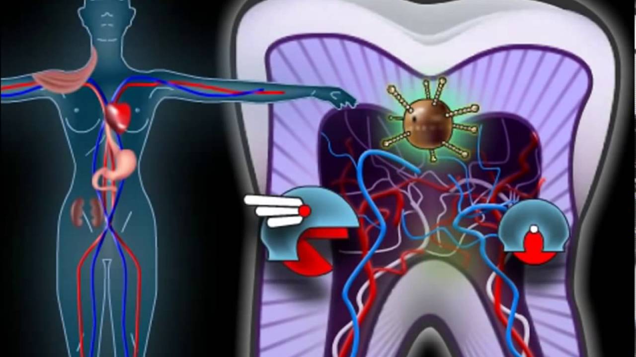 Пульпит - симптомы и лечение - YouTube