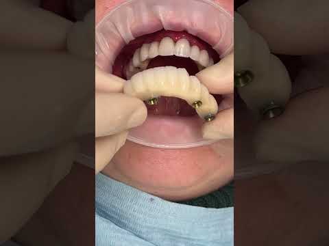 Reliable Dental Implant Results Johnstown OH