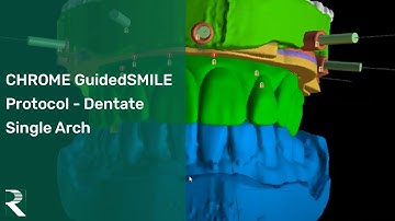 Nice CHROME GuidedSMILE Protocol - Dentate Single Arch