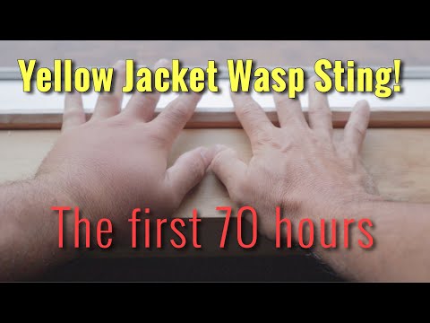 YELLOW JACKET WASP STING: The first 70 hours