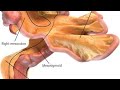 #MESENTRY STRIPPING ## OVARAINA CANCER #MUCINOUS ADENOCARCINOMA #SURGICAL  PROCEDURES
