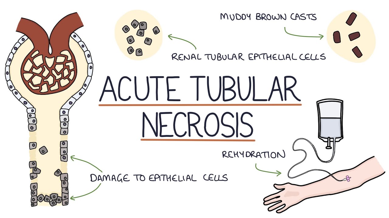 Understanding Acute Tubular Necrosis - YouTube