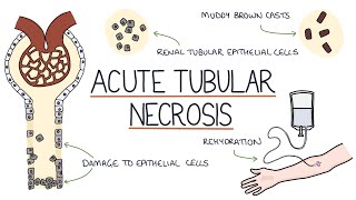Understanding Acute Tubular Necrosis screenshot 3