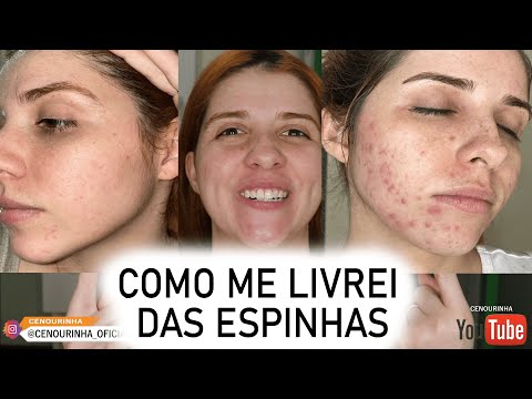Como eu me livrei das ESPINHAS (ACNE) sem gastar muito