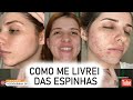 Como eu me livrei das ESPINHAS (ACNE) sem gastar muito