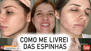 Como eu me livrei das ESPINHAS (ACNE) sem gastar muito screenshot 1