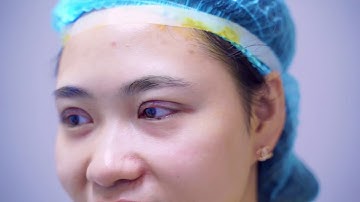 Cùng chiêm ngưỡng video cắt mí Mani Mini Deep 5D tại Dr.Hải Lê