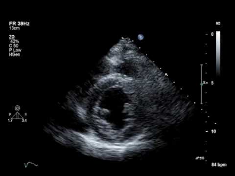 Hypokinesis, Mitral Regurgitation, Aortic Insufficiency 