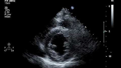 Hypokinesis, Mitral Regurgitation, Aortic Insufficiency
