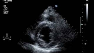 2-D echocardiography showing severe global hypokinesia and left