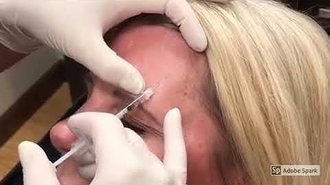 Allergan- Botox in Forehead