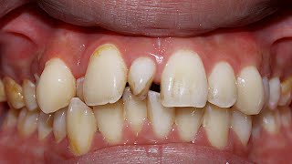 Sau 2 Năm Niềng Răng Sẽ Như Thế Nào? Results 2 Years Braces