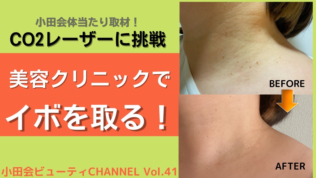 Vol.41 老人性イボを取る！ CO2レーザーに挑戦！！