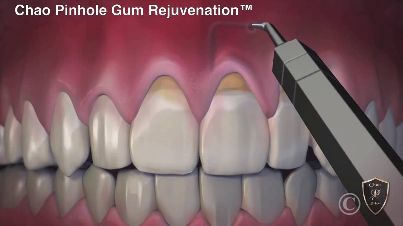 Pinhole Gum Rejuvenation™ Vs. Conventional Gum Grafting YouTube