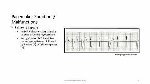 Pacemaker Overview