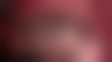 Intractable Trigeminal neuralgia caused by venous compression:MVD