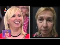 Remoção dos Papos nos Olhos (Blefaroplastia - Antes e Depois) - Drª Luísa M. Ramos no Você na TV