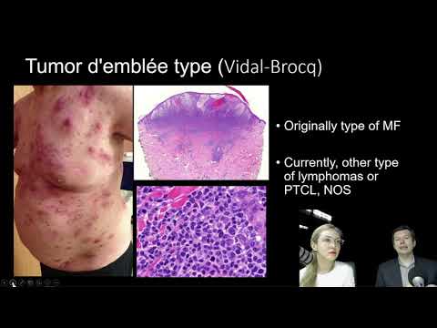 Video: Kan du dø av mycosis fungoides?