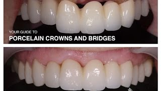 Porcelain Crowns and Bridges