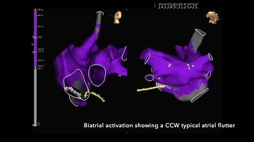 Atrial fibrillation catheter ablation (Redo AF)