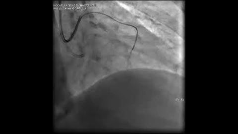 Aortic dissection and radial rupture during retrograde CTO PCI: Management of complications VİDEO 6