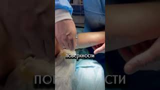 Брахиопластика.