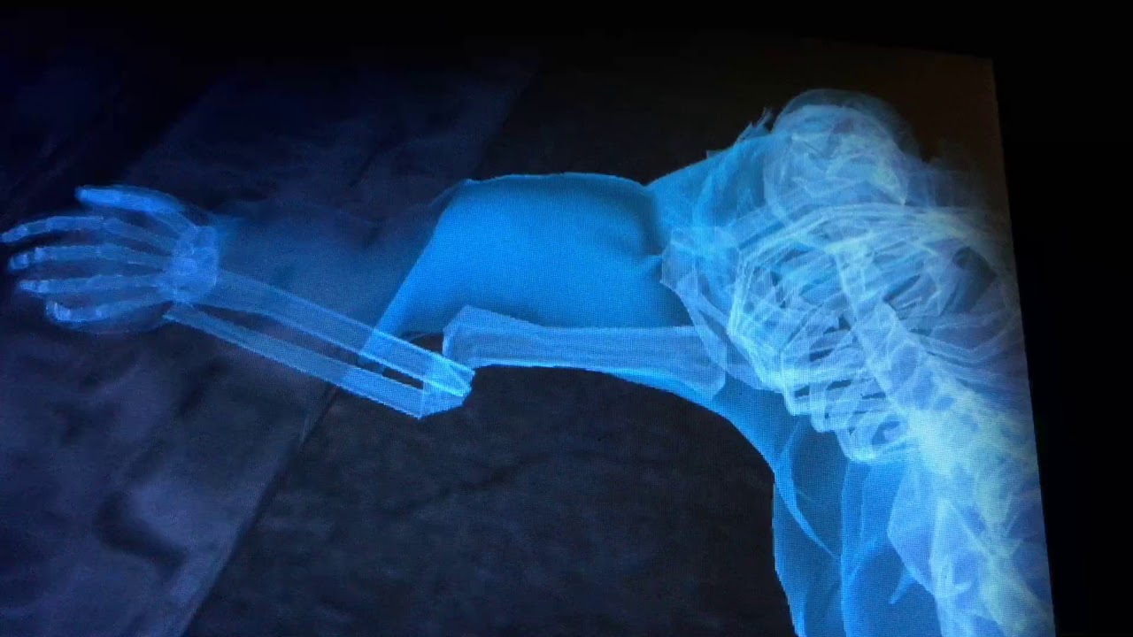 Batman Arkham City Completely Broken Arm No Way For A Fix Youtube